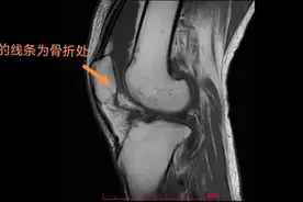 锻炼时猛力甩腿，六旬老人竟将膝盖“甩”骨折图片