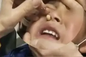 过于自信？女子往鼻孔塞珍珠，结果坏了！图片