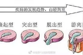 腰椎间盘突出有哪些类型？图片