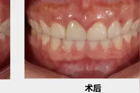 牙齿残根残冠还能保留吗？北京大学人民医院口腔科专家：别急着拔，或许还有用图片