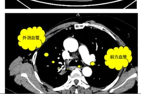 微创治癌新方式  小粒子精准杀癌图片