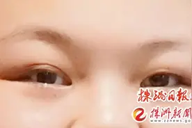 睫毛倒长，致角膜严重擦伤！图片