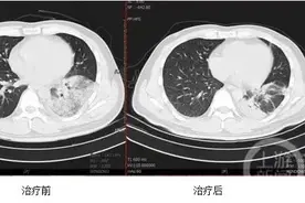 西南医院接诊一例“鹦鹉热”患者，专家提醒图片