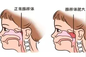 孩子耳朵听不见了，竟是嘴巴呼吸惹的祸？图片