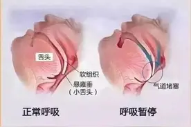 男子骑车时曾陷入迷糊，竟然还打起鼾来，医生：这个综合征不是小事！图片