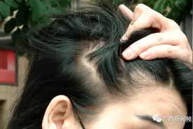 南宁一女子拉直发后，差点“秃”了……图片