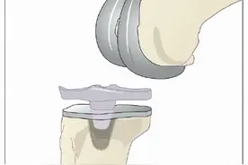 人工关节是用什么材料制造的？图片