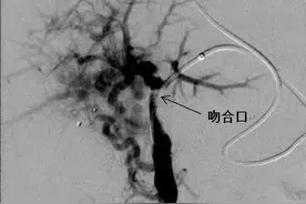 【儿研所儿医说】门脉海绵样变Rex术后脾大不缓解怎么办？图片
