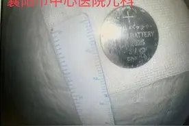 1岁宝宝误吞纽扣电池 医生无痛胃镜顺利取出图片
