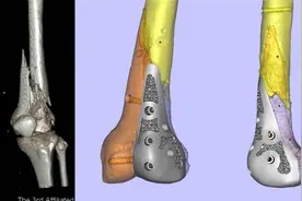 男子车祸摔破膝关节 3D打印钛合金假体补上 恢复正常行走图片