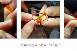 小伙全身“发黄”胆汁中“爬出”数十条寄生虫，疑与爱吃鱼生有关图片