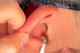 男子浮潜时小螃蟹意外爬进耳洞，上网各种找办法才将螃蟹取出视频封面
