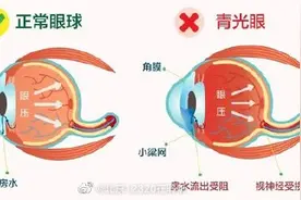 那些人容易得青光眼？图片