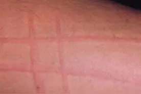 皮肤一划就是一道痕，这是什么怪病吗？图片
