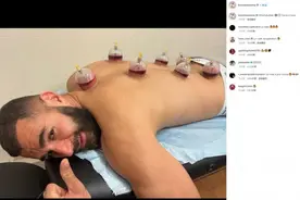 拔罐狂魔！本泽马给中医拔罐点赞图片