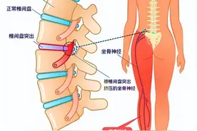 明明是腿痛腿麻，为什么偏说是腰椎出了问题？图片