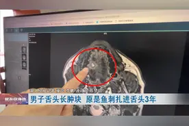 男子舌头长肿块，一检查才发现…医生提醒：小心癌变！图片