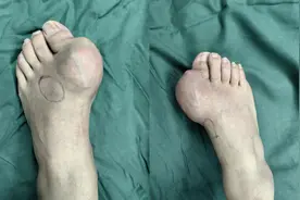 四肢长出鸡蛋大小的“石头”，35岁男子诉苦：鞋子都穿不进图片