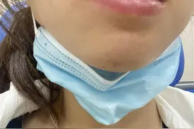 女子睡梦中嘴被蜈蚣咬肿成“香肠”，医生：可用肥皂水冲洗图片