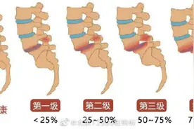 什么是腰椎滑脱？图片