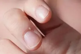 手上长倒刺，是因为缺少维生素吗？图片