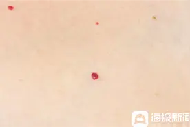 身上起了“小疙瘩”是过敏导致？德州市第二人民医院医生：莫担心图片