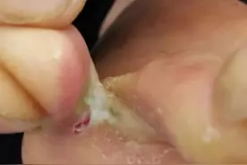 健康小站丨脚气“最喜欢”的季节来了，防治看这里！图片
