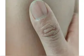 热闻|指甲上突然长了一条黑线上热搜！网友慌了！长这几种指甲的人注意图片