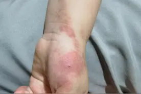 咬一口红疙瘩起一片！夏日“虫虫特攻队”出没，到皮肤科就诊的儿童扎堆了图片
