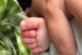 谁能想到，一根头发竟险些让宝宝截肢？图片