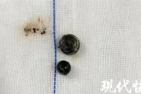 电池与弹珠塞入鼻孔，9岁男童鼻黏膜组织大面积坏死图片
