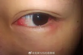眼睛突然红了怎么办？图片