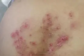 游完泳，孩子连得3种病……图片