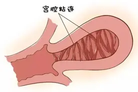 宫腔粘连会导致不孕，这几个症状要格外警惕图片