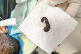喝生水、用生水洗脸！一男子反复鼻出血，竟是因为这个……图片