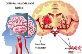 远离脑出血威胁，这些生活妙招快收藏！图片