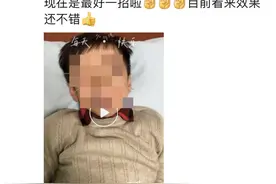 健康小站丨“卖相”吓人，疗效却真不错，中医针灸也能有效预防近视图片