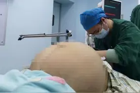 重42斤！福州一女子体内取出超大肿瘤！图片