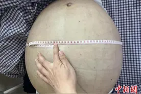 中新健康丨男子“腹大如鼓” 江西省人民医院团队为其切除病肝56.8斤图片