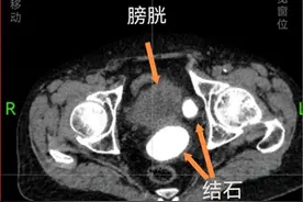 老人膀胱长出冬枣大结石饱受“不畅”之苦，微创手术两小时解除顽疾图片