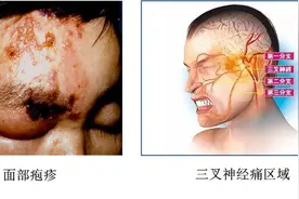 摸头发就疼痛难忍？这个特殊病例占比不到1%，医生提醒→图片