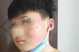 16岁少年遭红斑狼疮“袭击”器官衰竭，医护人员24小时全力抢救5天助他重获新生图片