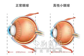 7旬爹爹婴儿般小眼球爆发青光眼 妙手除障降压保住独眼光明图片