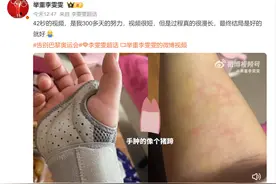 李雯雯晒手肿视频，自言“像猪蹄”图片