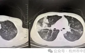 高烧两天后20岁壮小伙被送进了重症监护室！医生提醒：“硬扛”可能会致命！图片