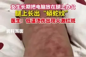 女生长期把电脑放腿上办公长出蟒蛇纹 医生提醒：早期火激红斑能够自愈图片