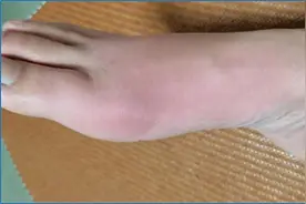 痛风为何“偏爱”中老年男性？专家提醒：痛风可防可治，科学管理是关键图片