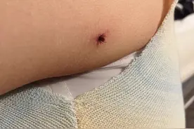 孩子野外露营被蜱虫叮咬，医生提醒：家长千万别这么做！图片