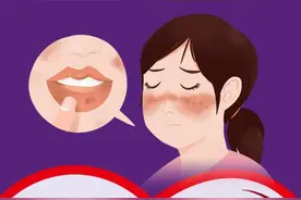 红斑狼疮到底是什么病？为啥育龄期女性高发？图片