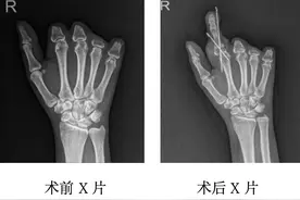 隔着屏幕都疼！49岁惠州女子脚趾“移花接木”变手指图片